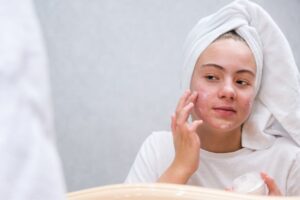 Leia mais sobre o artigo Melhores hidratantes para a pele com acne: Guia completo para escolher o ideal